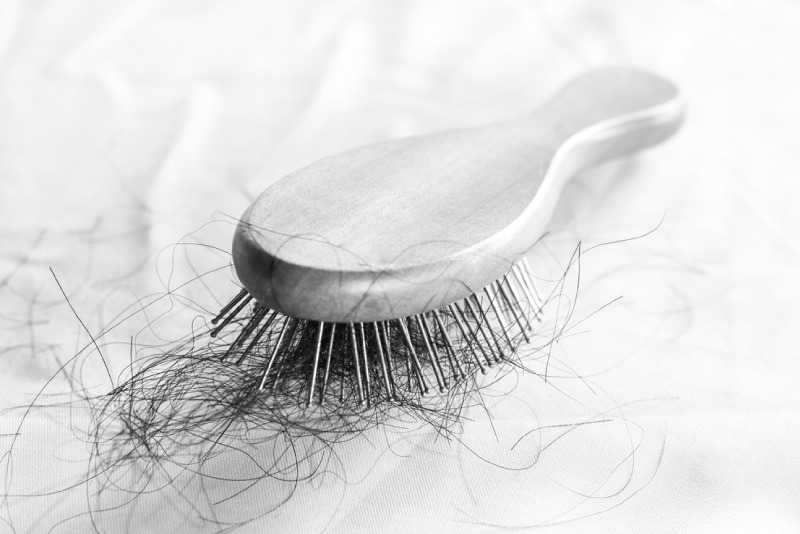 Minoxidil Oral na Alopecia Androgenética Feminina